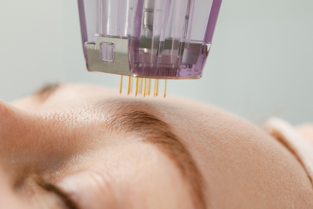 Microneedling Aftercare: What to Do After Your Treatment